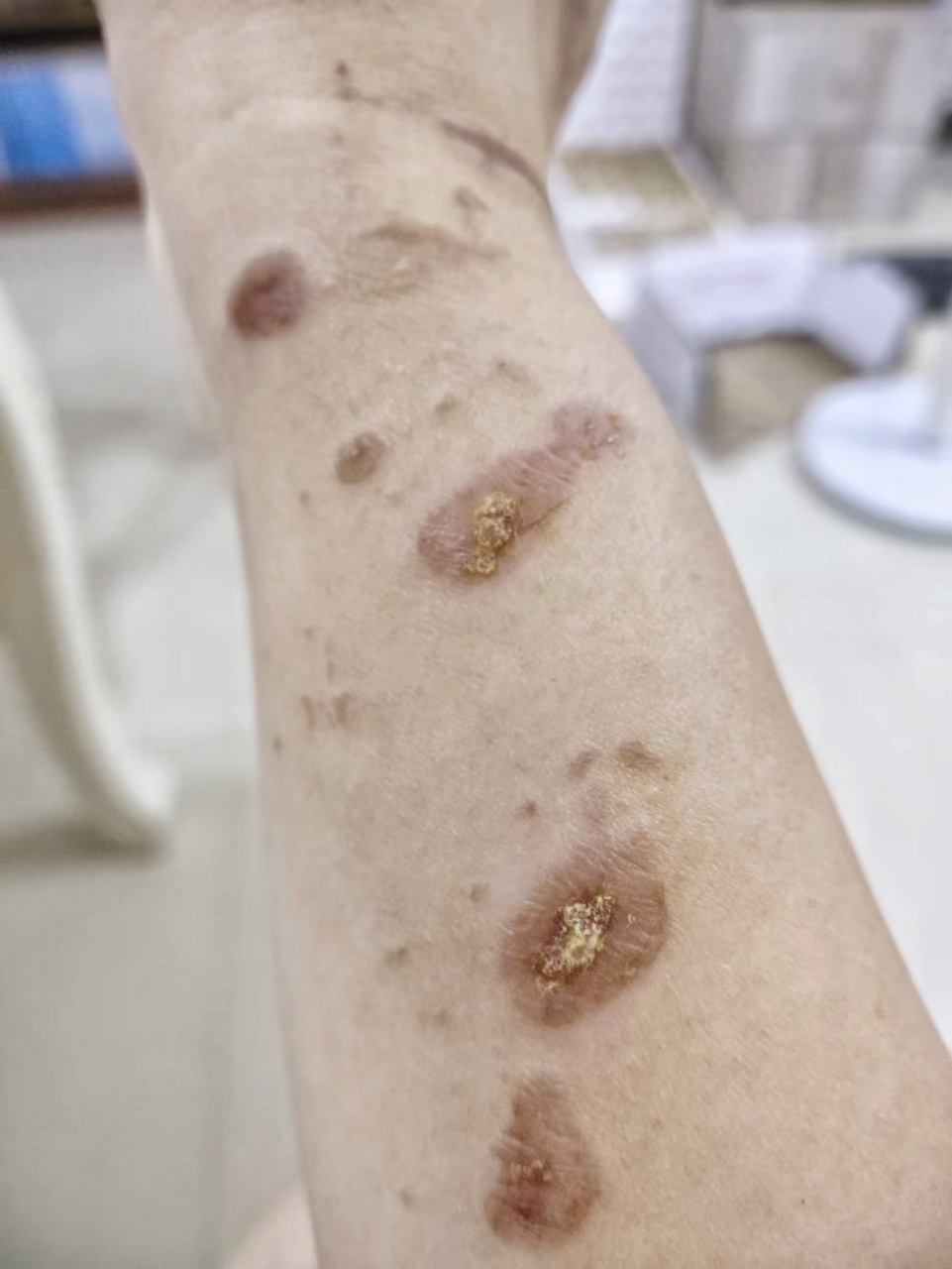 胳膊消肿了,也不疼了,水泡溃烂结痂了.
