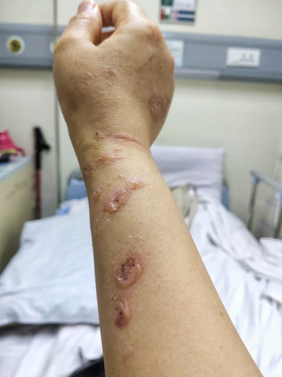 造影剂外渗事故的发生,不仅让我遭受了肉体的摧残,还承受了极大的精神