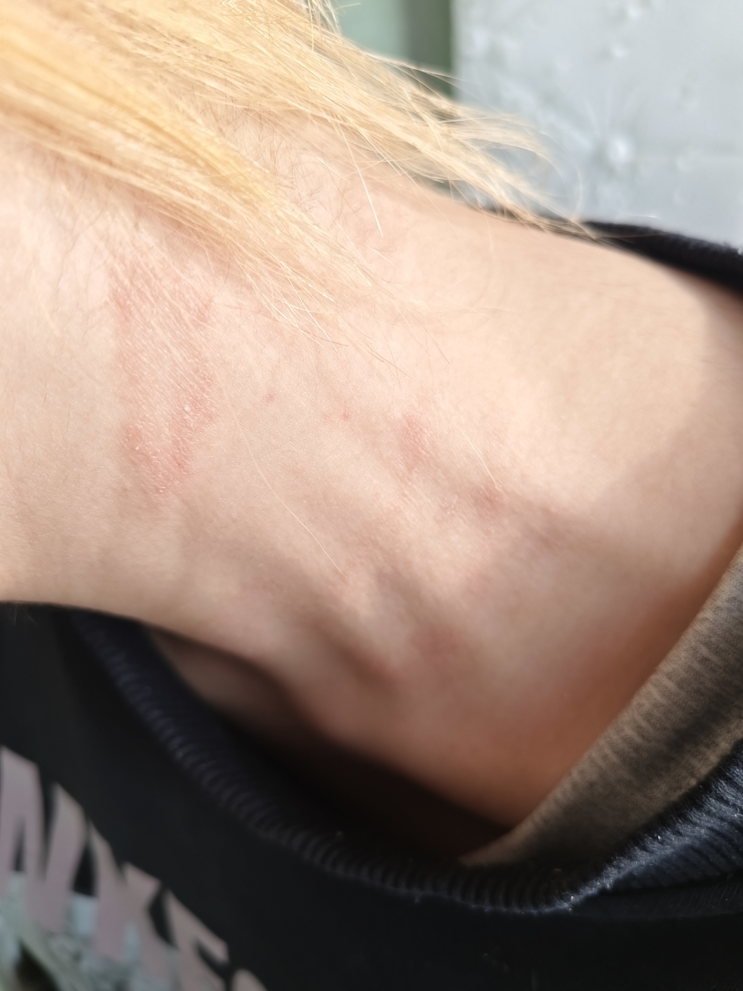 请问孩子脖子左侧长了这样的东西,是癣还是过敏?不痒