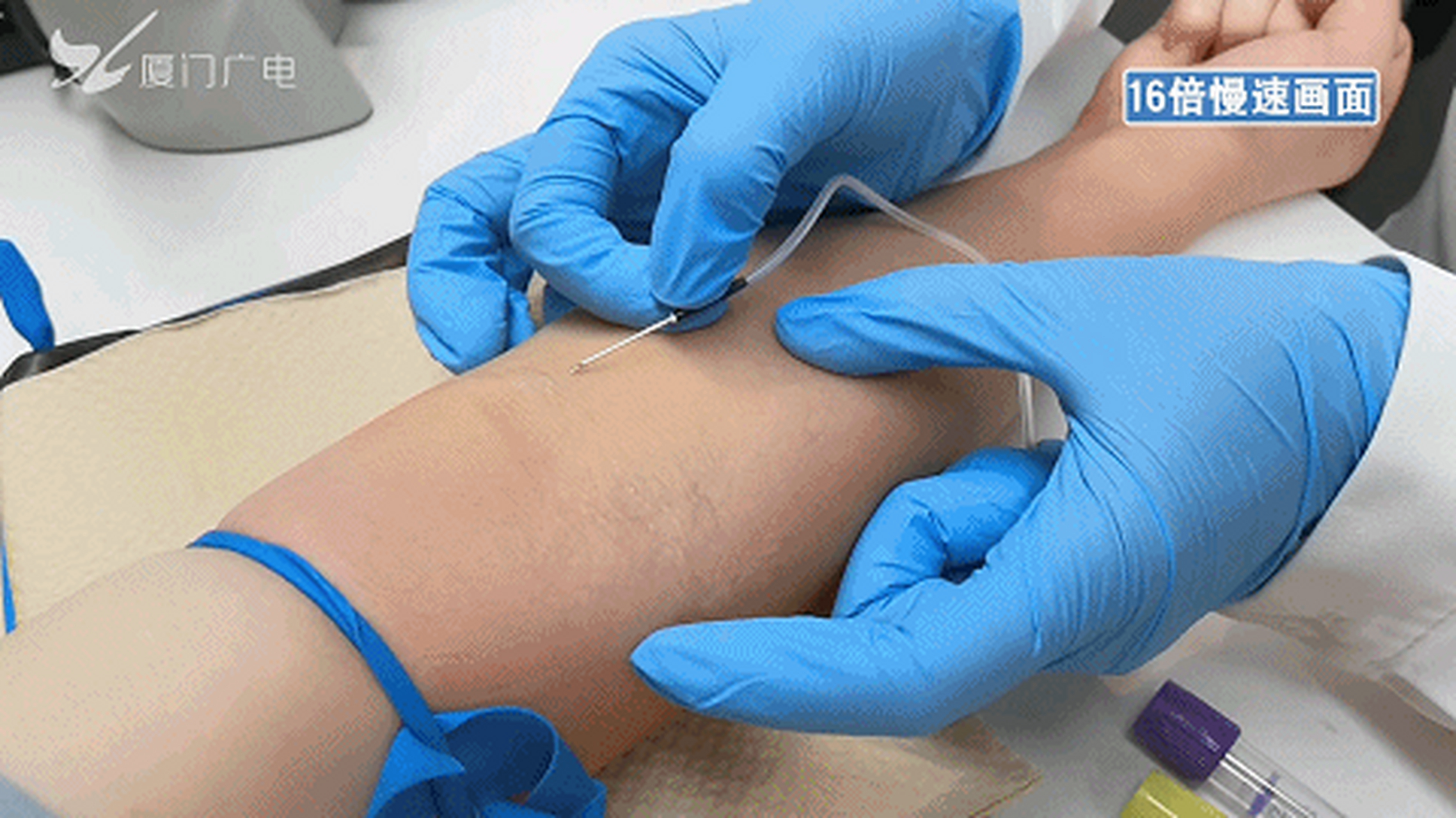 为减轻患者痛苦,95后男护士苦练"飞针"技术!