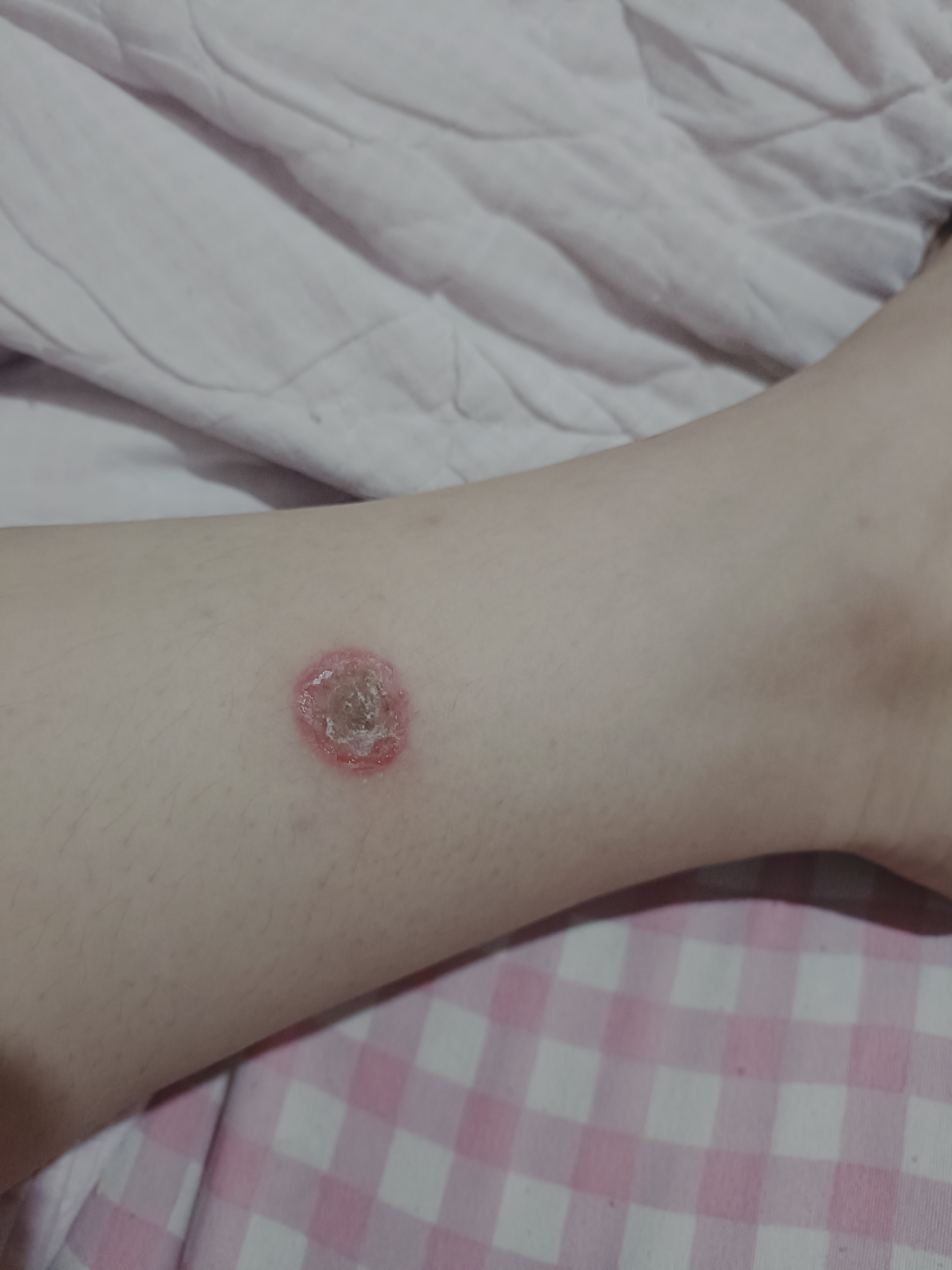 感觉越长越大,莫匹罗星软膏,红霉素软膏,还有口服