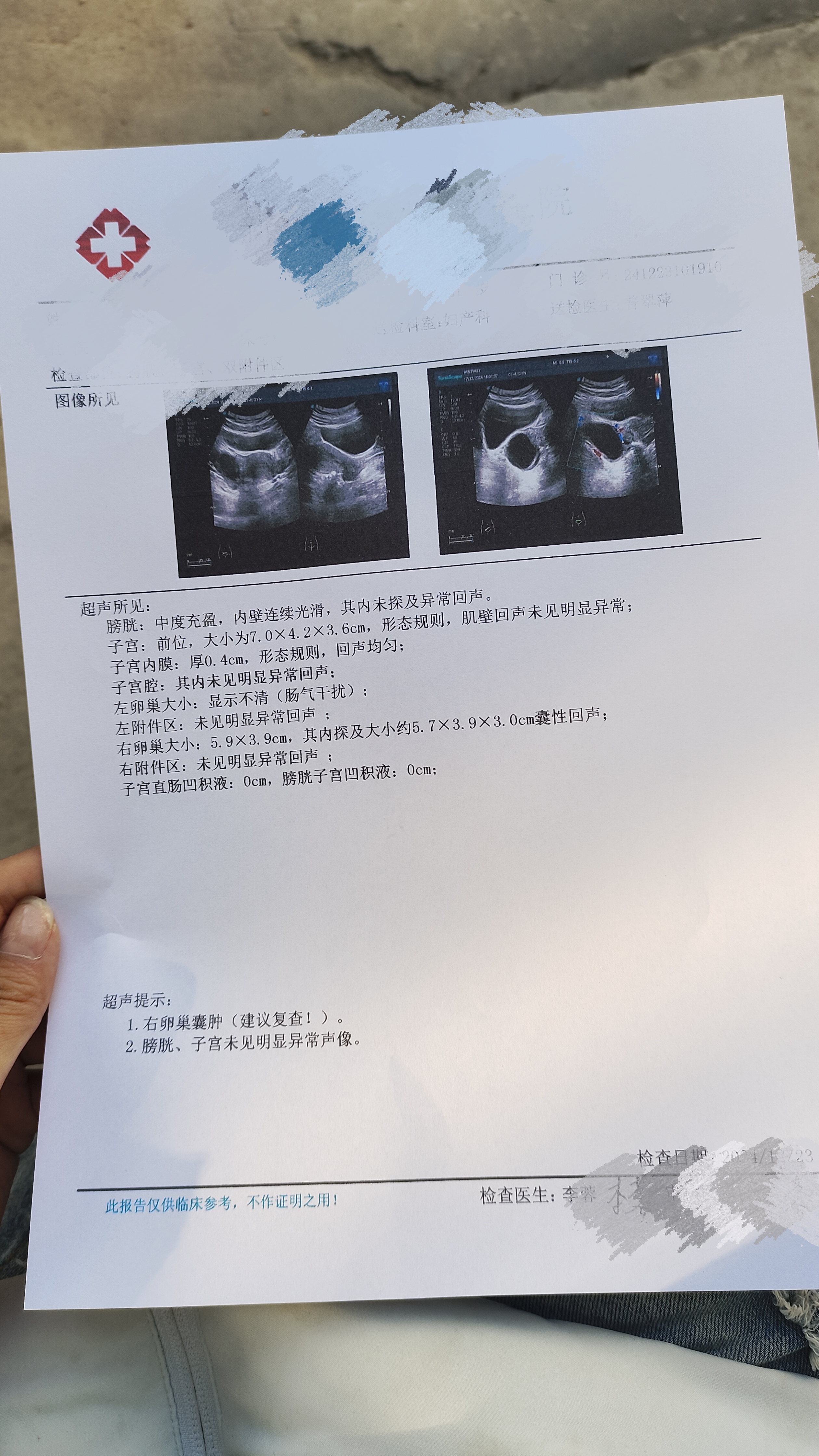 有没有医生朋友帮忙看看,这种严不严囊肿随月经排出图片黄体囊肿彩超