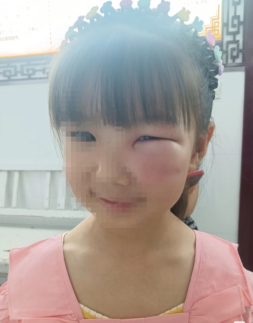 一个眼睛都被咬的都一丝缝了,老师打电话给我,很委婉的问怎么了,还