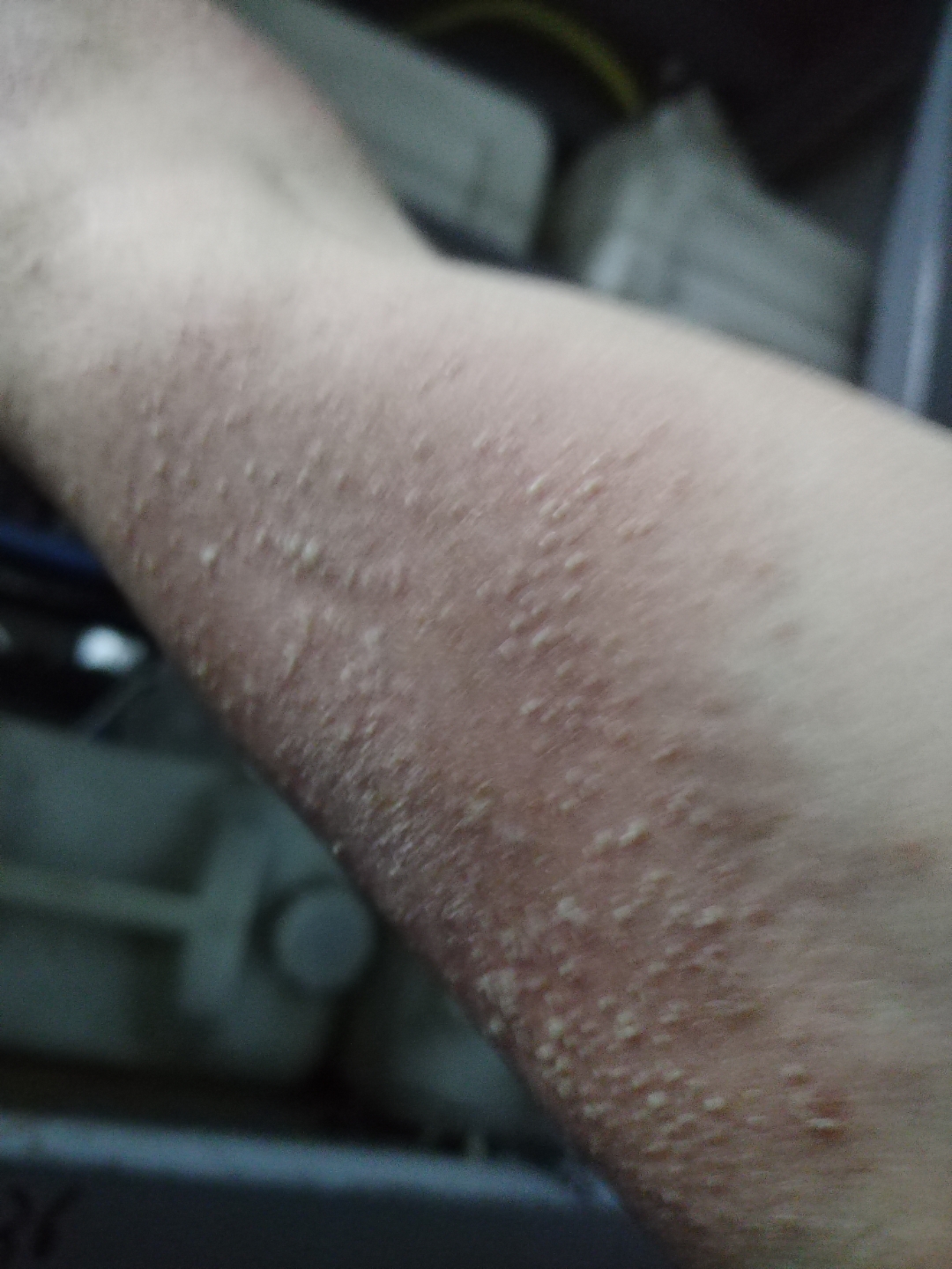 吃蜂蜜过敏是什么症状(蜂蜜吃了过敏了痒的我受不了怎么办) 吃蜂蜜过敏是什么症状(蜂蜜吃了过敏了痒的我受不了怎么办)