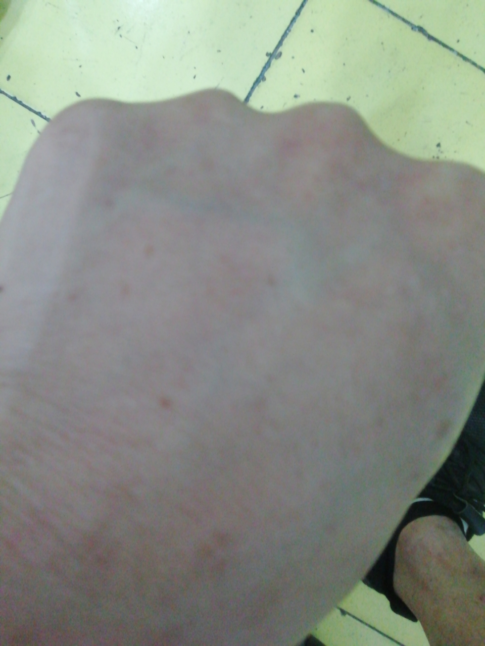 有没有治这种扁平疣的方子,手上好多小点