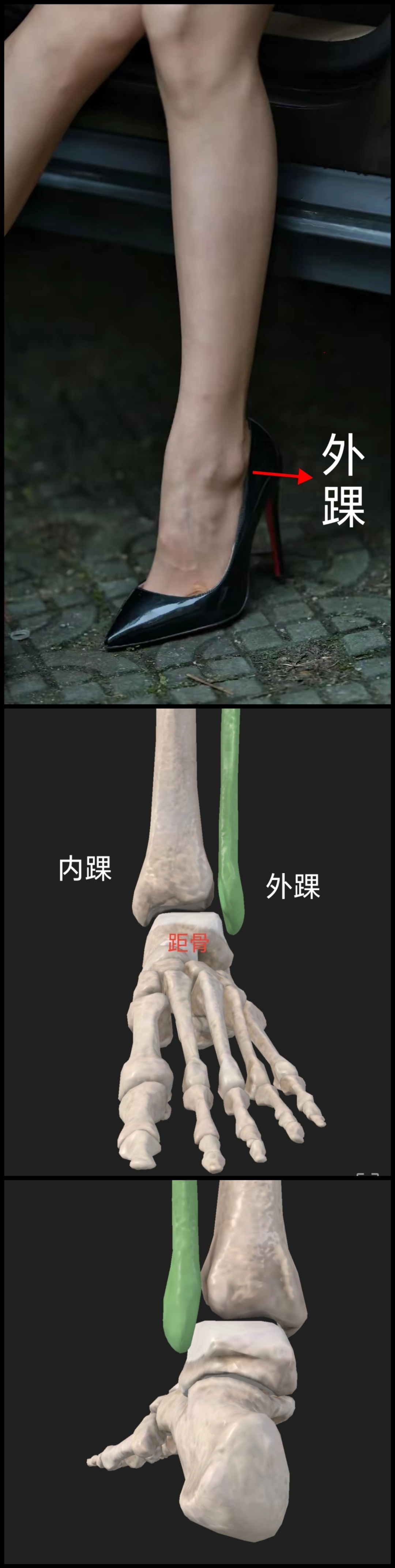 每个人脚脖子外侧都有一个疙瘩,这个太大不好看,这个疙瘩其实