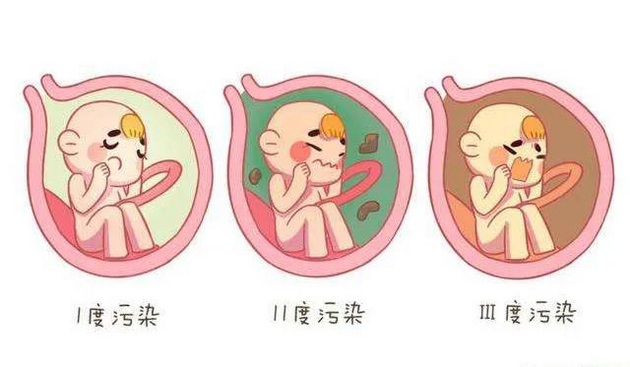 西安安琪儿妇产医院:胎心晚减,羊水污染要剖吗?