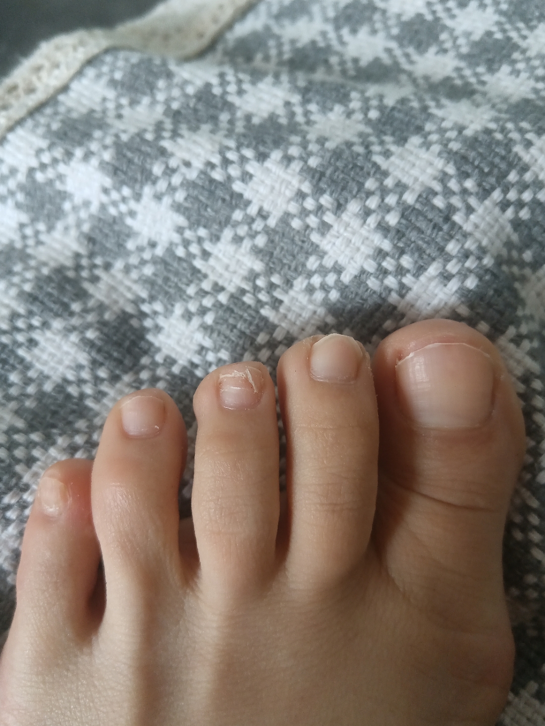 脚趾甲空了一块什么问题,有哪位大神知道?