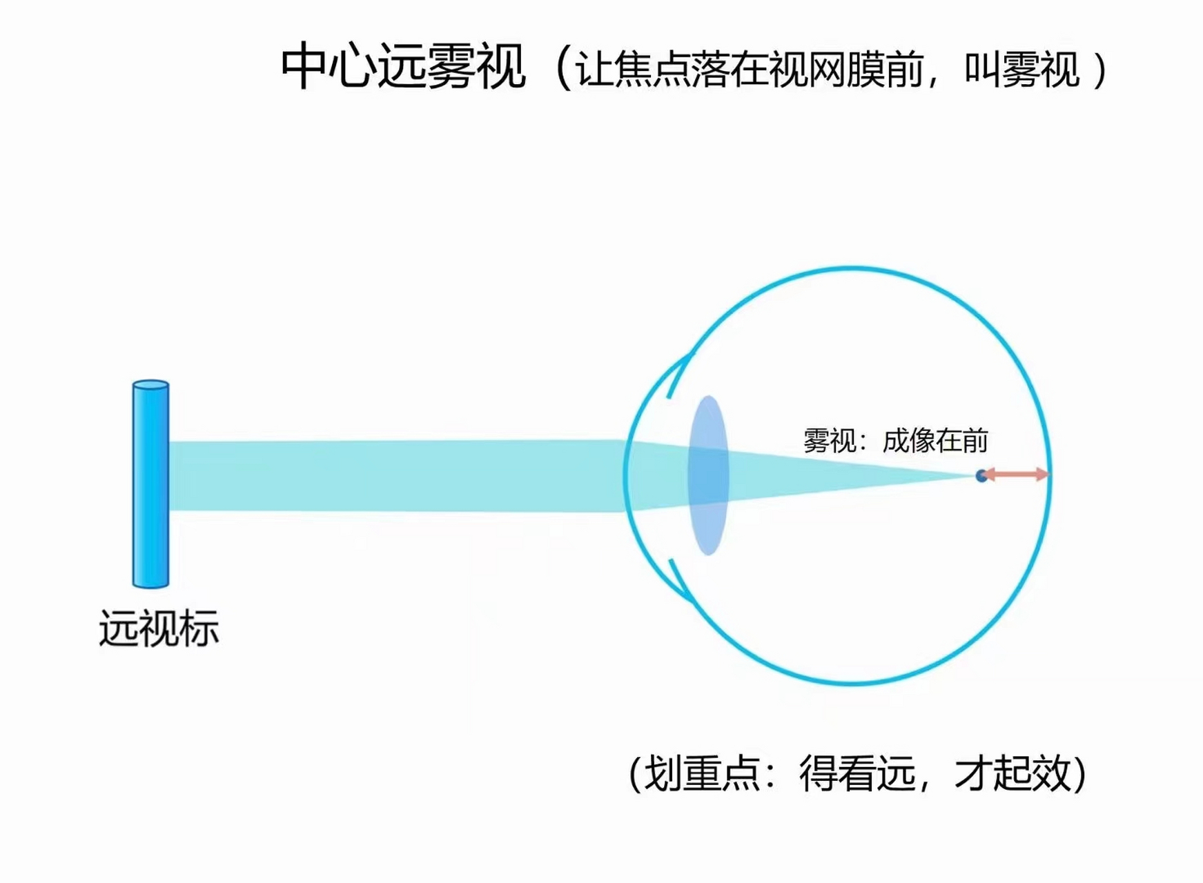 离焦眼镜(新乐学,星趣控), 其实是从雾视原理衍生出来的, 67离焦