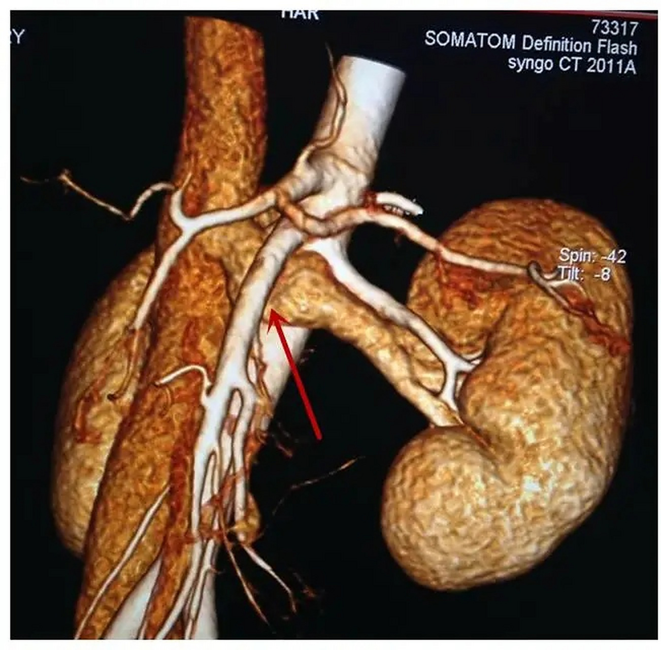又称左肾静脉压迫综合征,是由于左肾静脉穿行于腹主