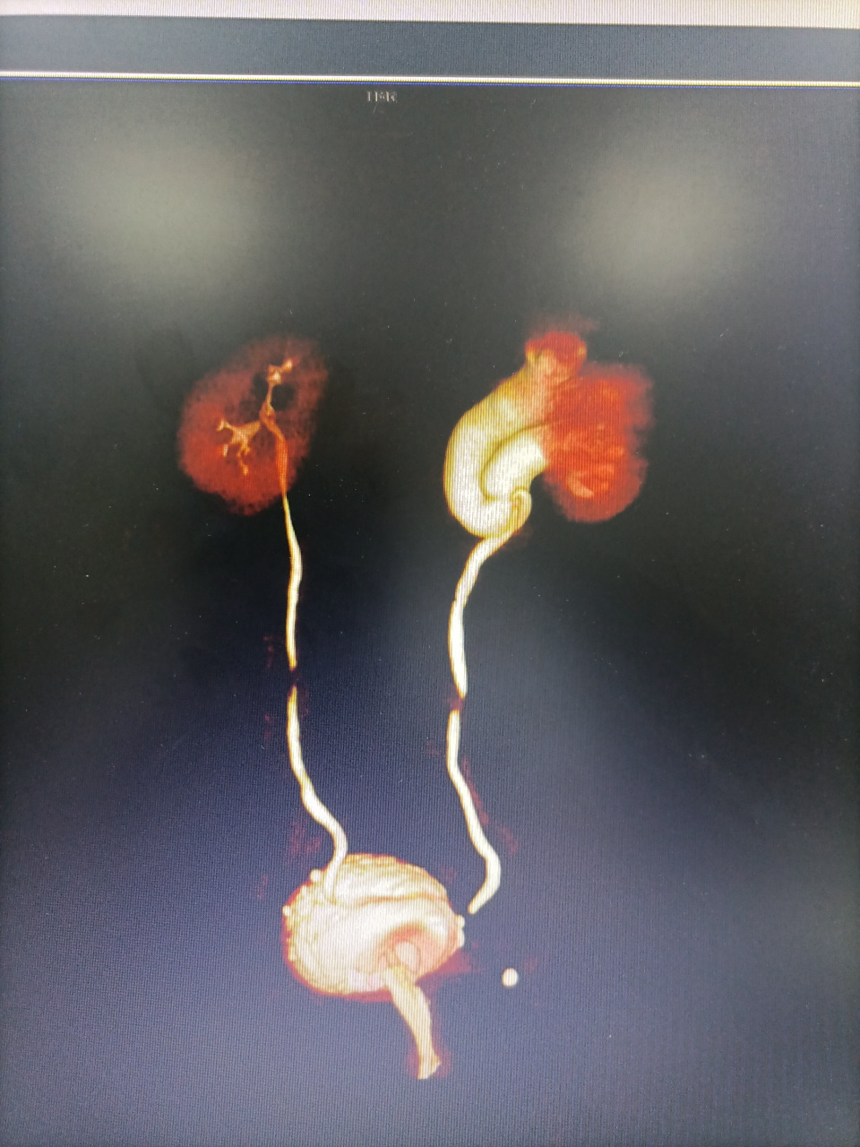 右侧双肾盂畸形!