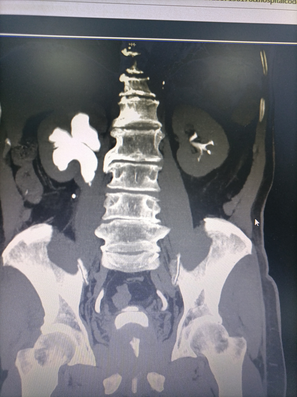 右侧双肾盂畸形!