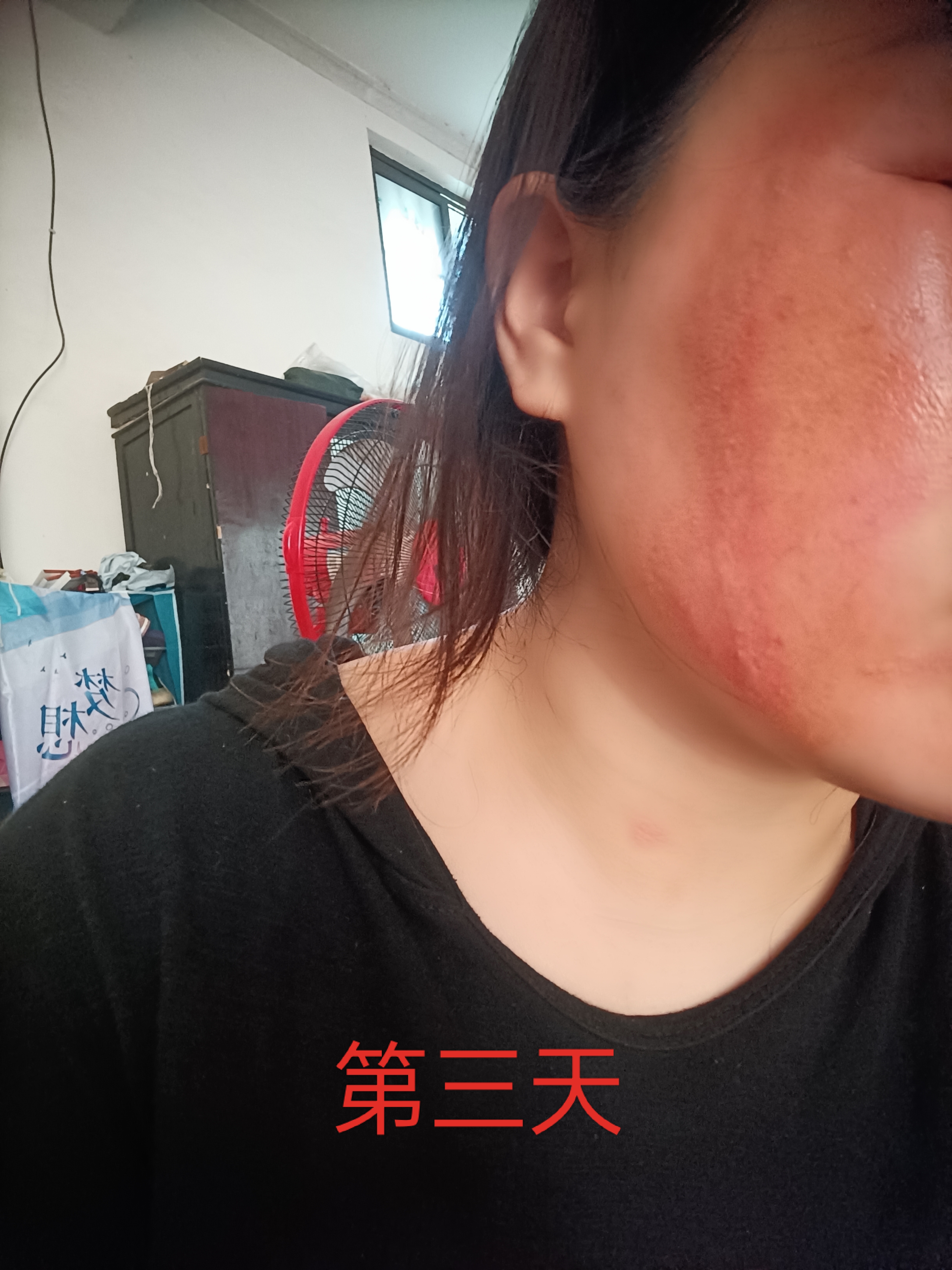 家里住在16楼,被隐翅虫咬了过程,不疼,就感觉发热,后面发痒