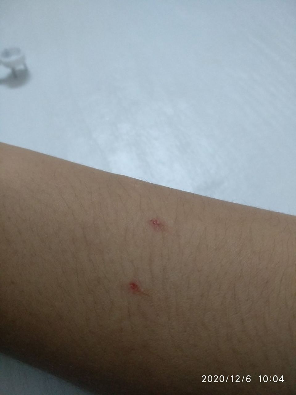 被蟑螂咬了怎么办?#被蟑螂咬了