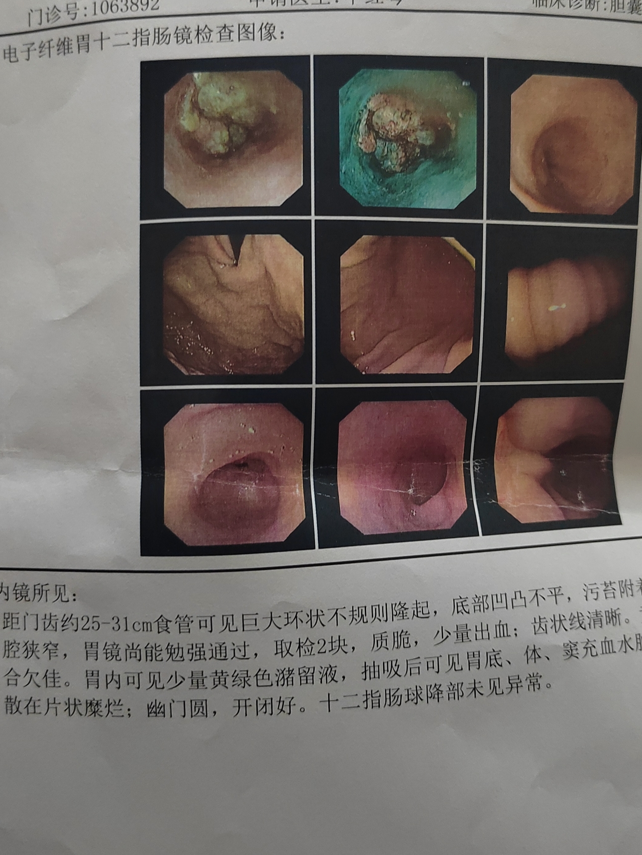 父亲73岁,查出食管鳞状细胞癌中分化,大家看看有什么好的办法吗?