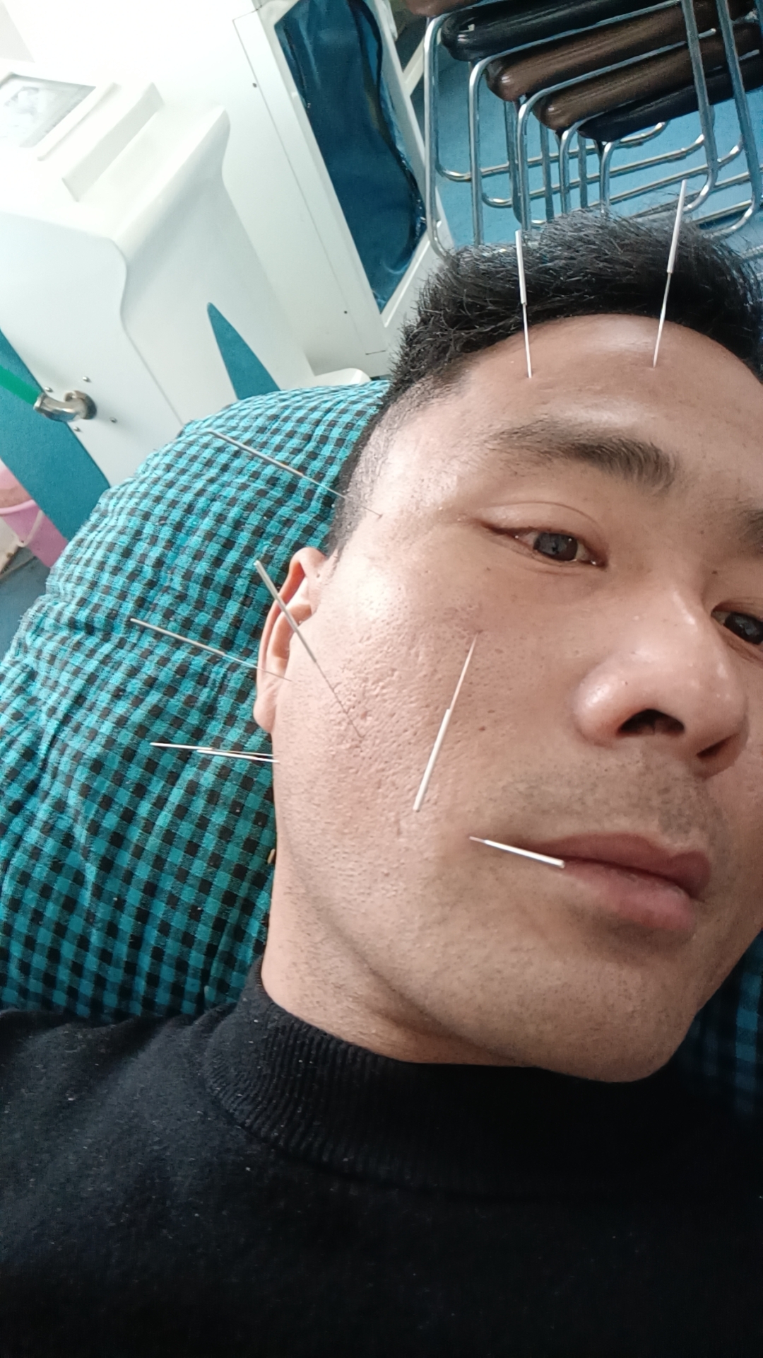 02 针灸大师秀神技,面部针灸惊现新境界!