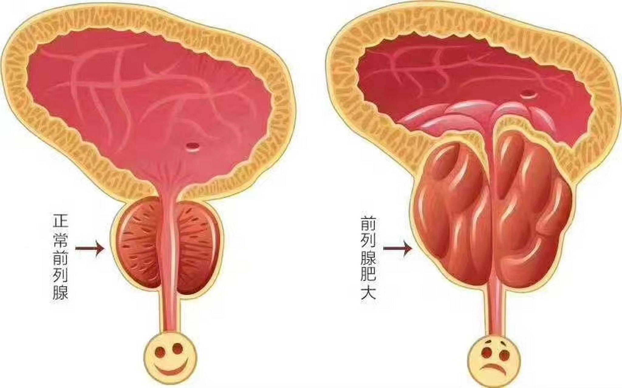 最近有网友问我,前列腺肥大需要手术吗 前列腺肥大是由于男性年龄