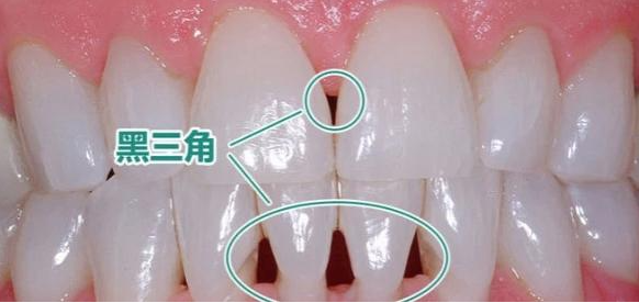 牙齿黑三角怎么形成的?