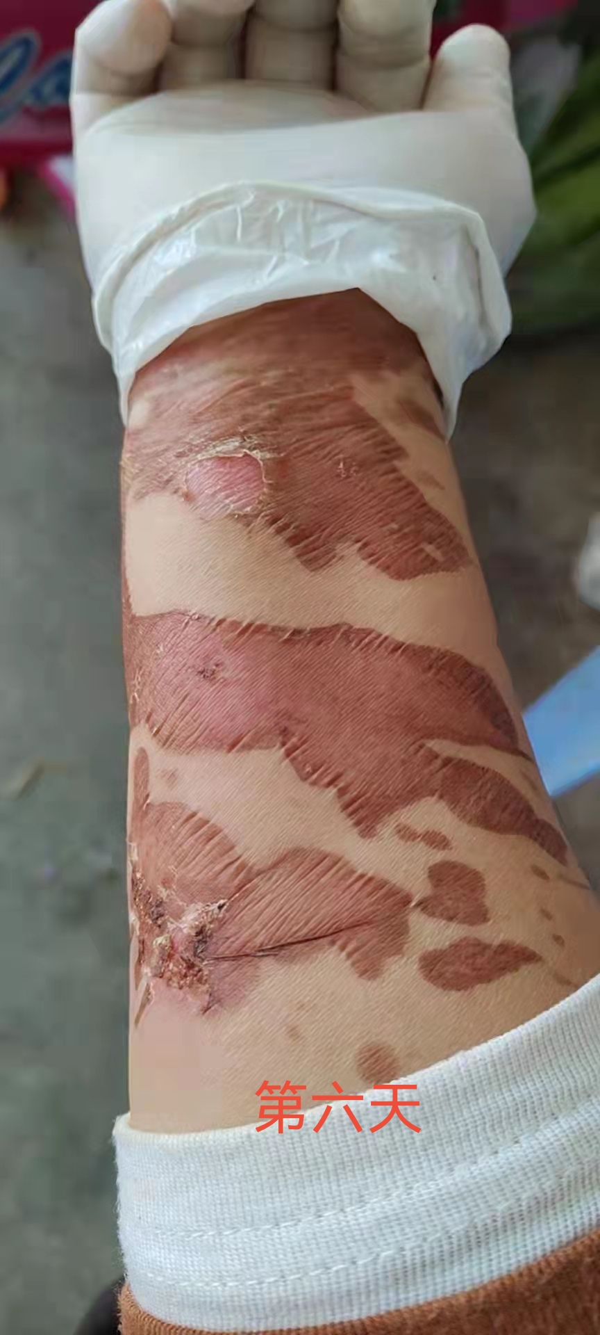 这是被猪油烫伤的手,用我的烧烫伤药后到第九天时,基本完全长出了新皮