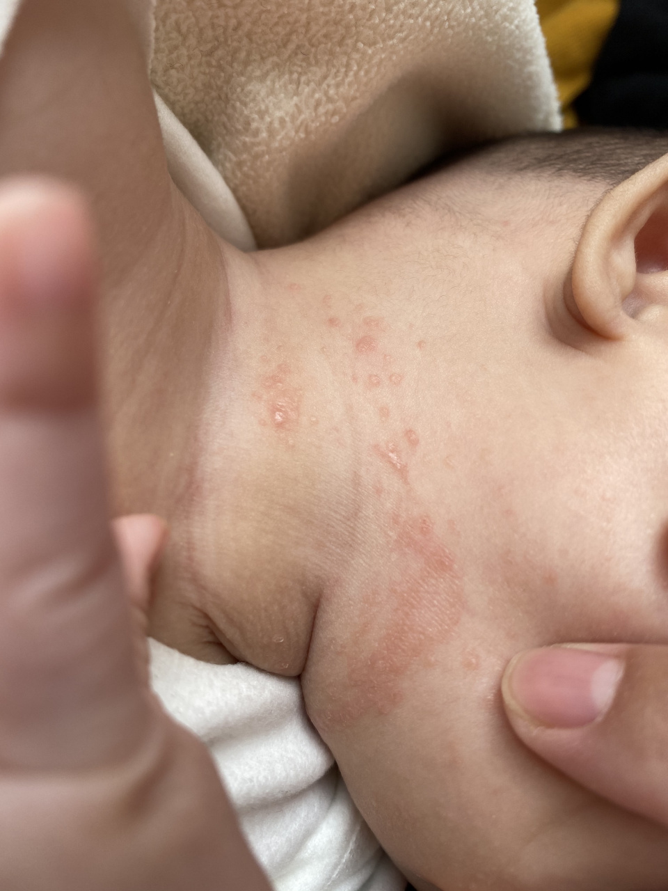 湿疹症状图片 婴儿图片