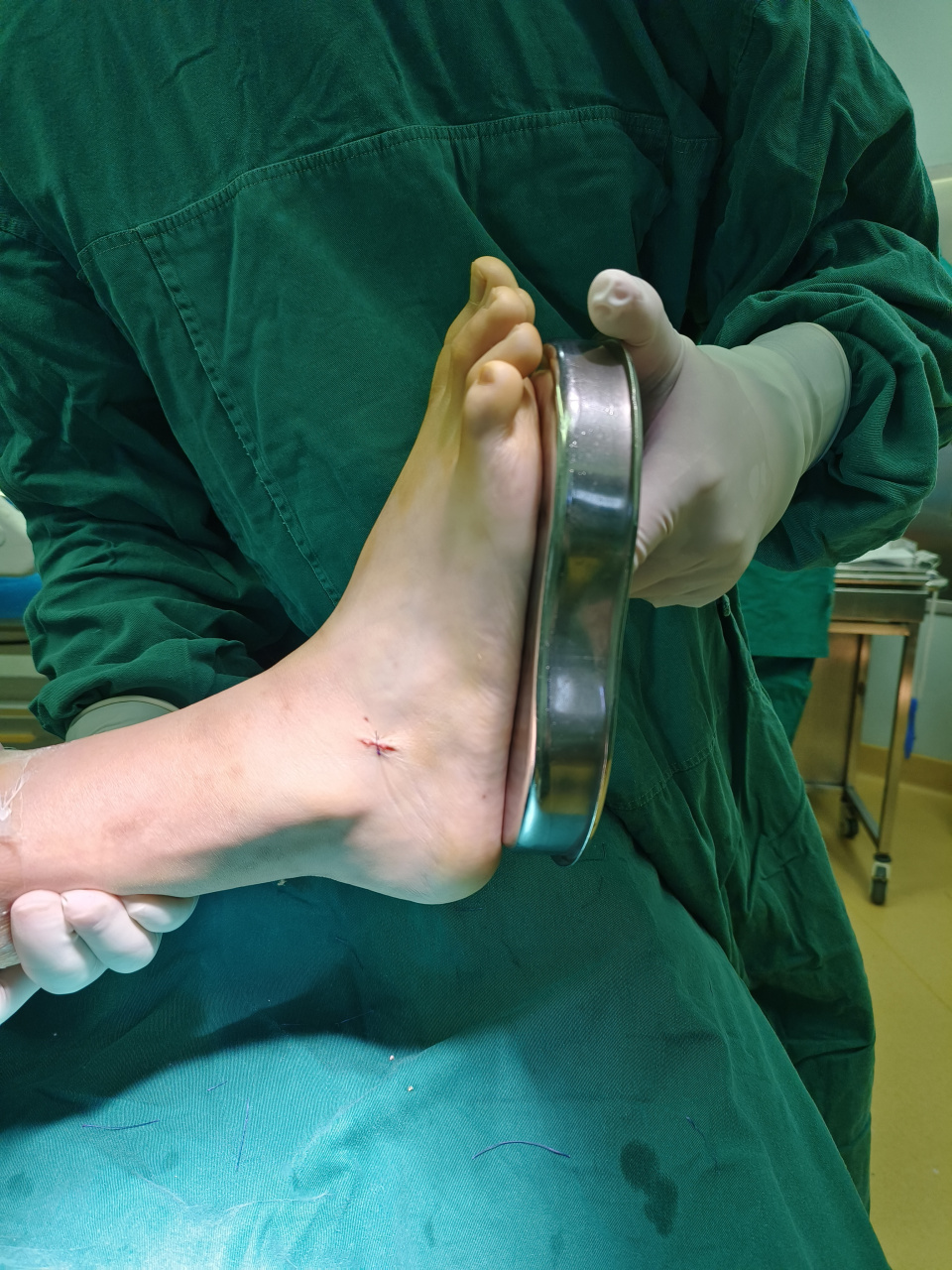 青少年扁平足#扁平足# ,微创治疗,让孩子足部更健康!