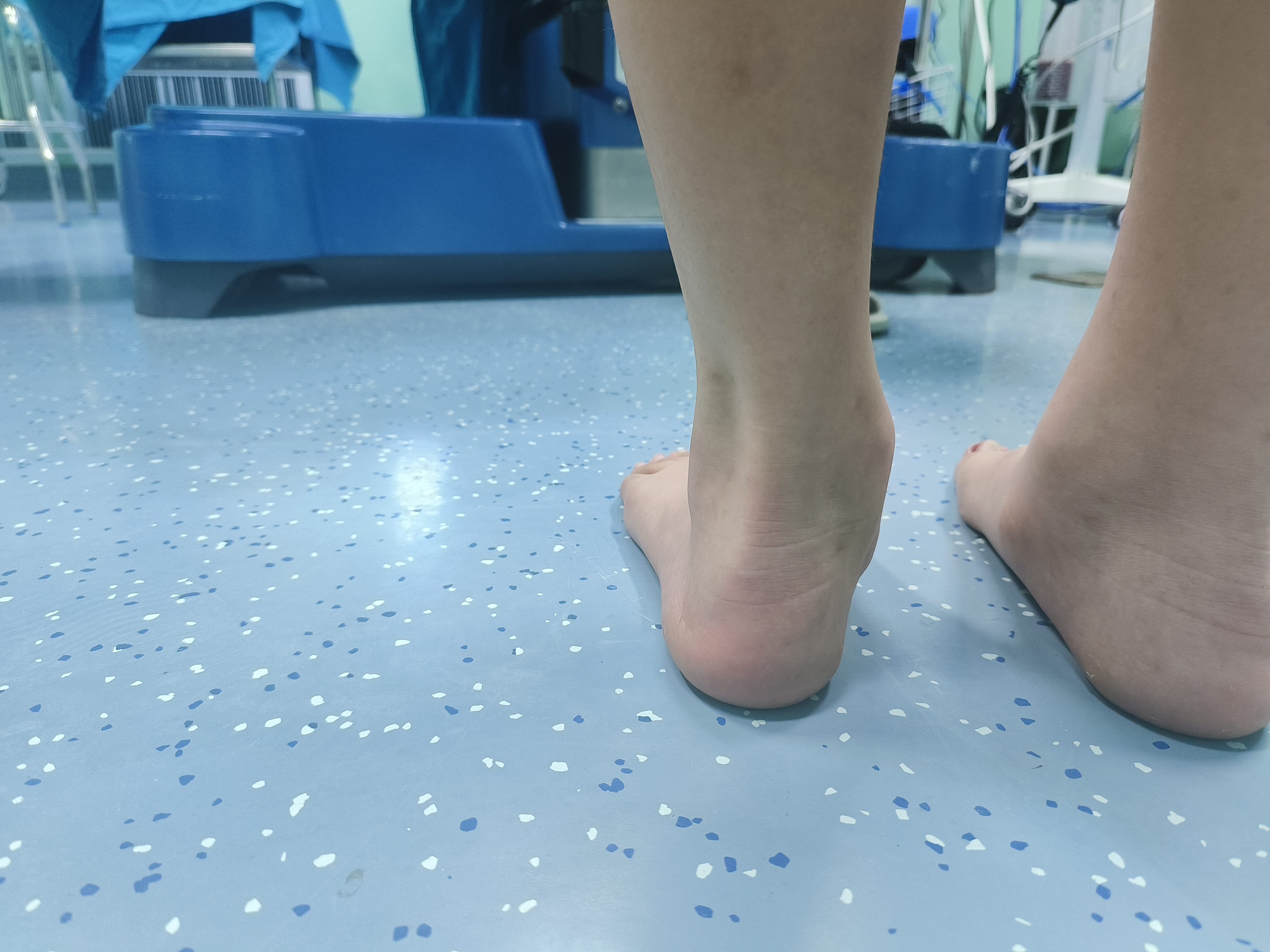 儿童扁平足,主要是距下关节不稳定导致,采取距下关节制动螺钉,小切口