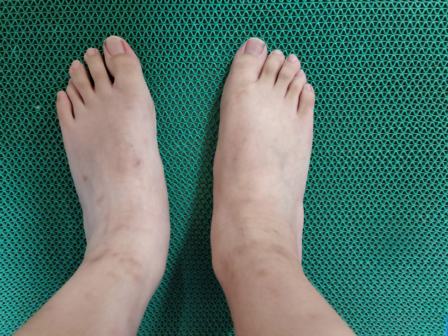 青少年扁平足#扁平足# ,微创治疗,让孩子足部更健康!