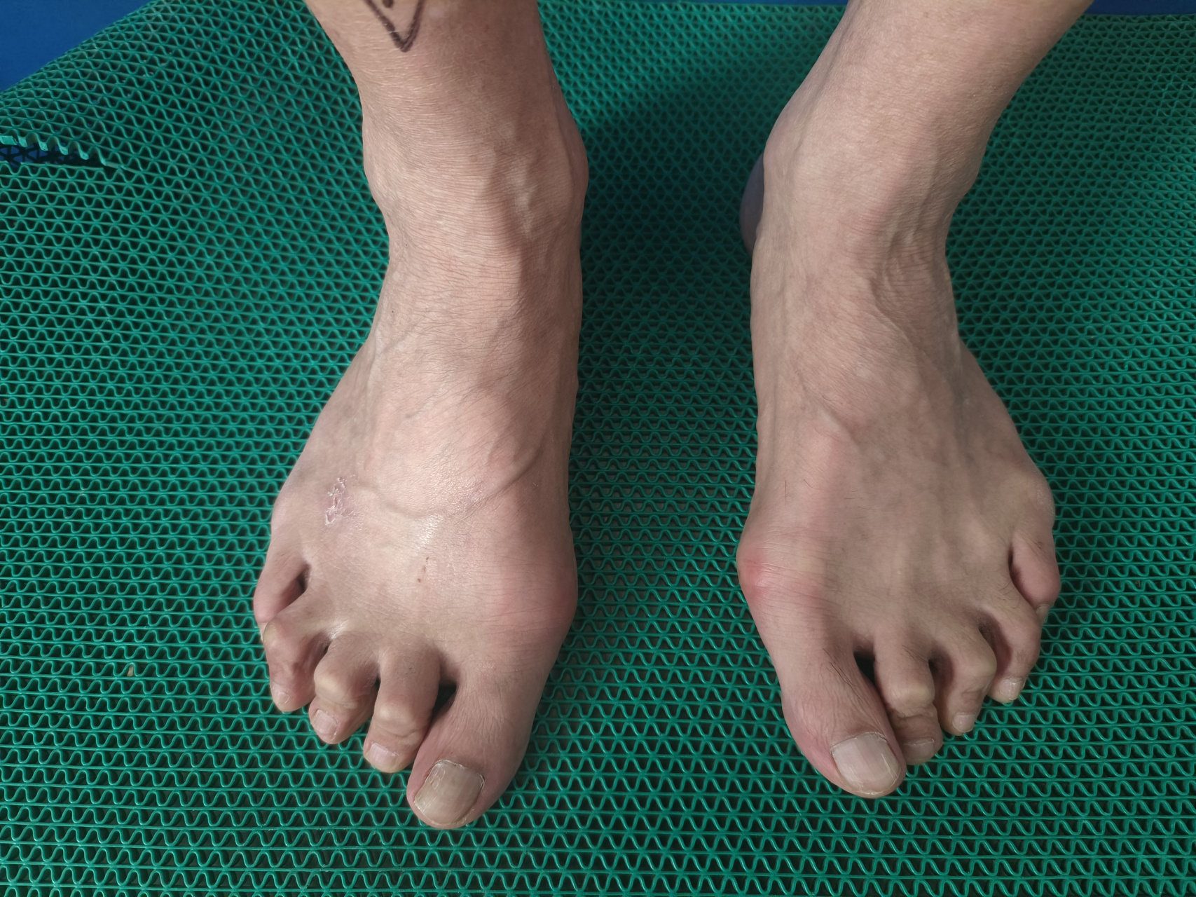 拇外翻# 55岁男性