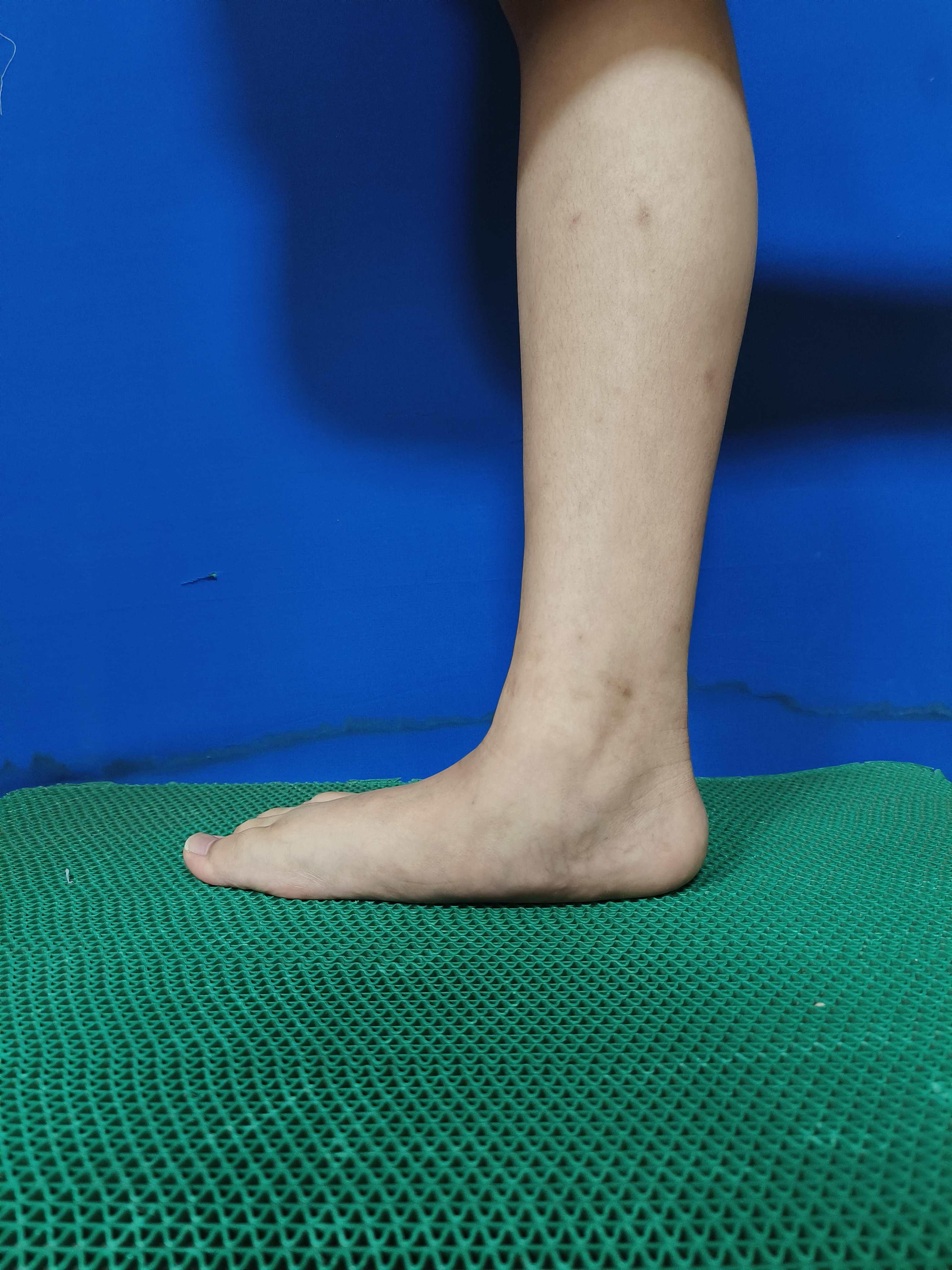 青少年扁平足#扁平足# ,微创治疗,让孩子足部更健康!