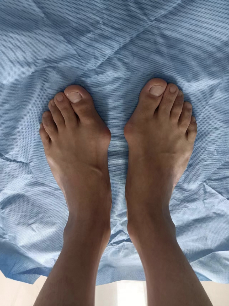 双足#拇外翻# 拇外翻,32岁男性,经皮克氏针固定,免去内固定烦恼!