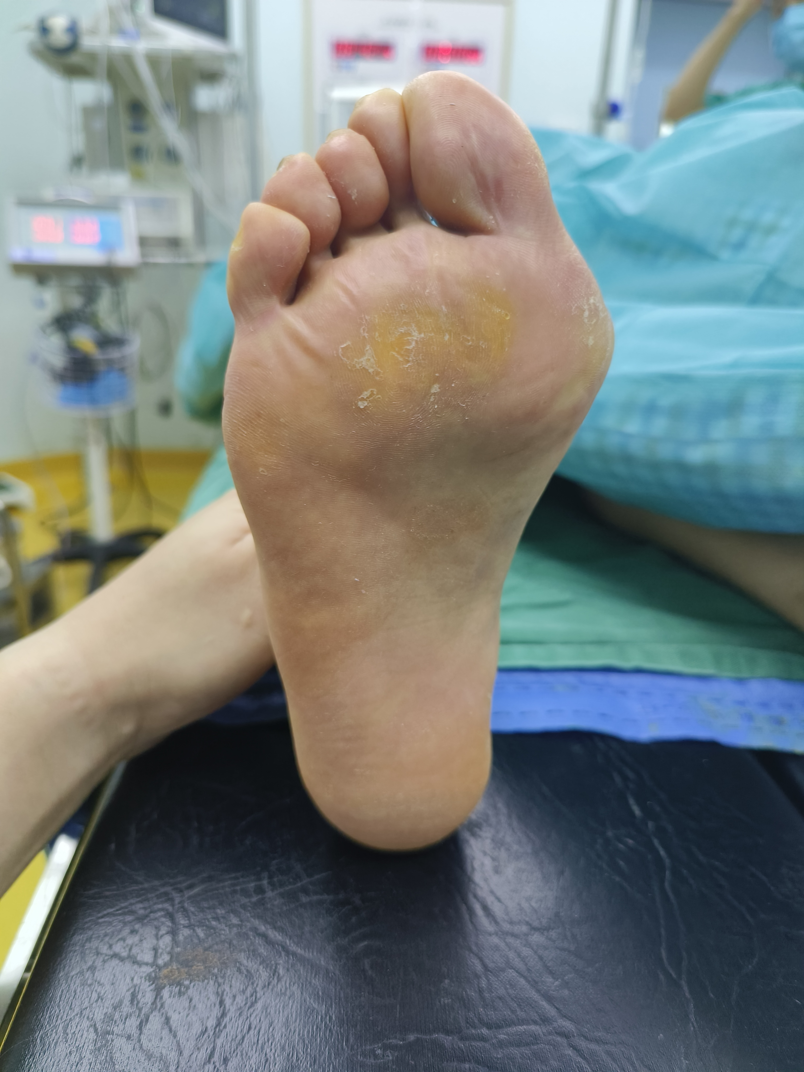 59岁女性拇外翻,前足足底大片胼胝体,自诉腿伸直时