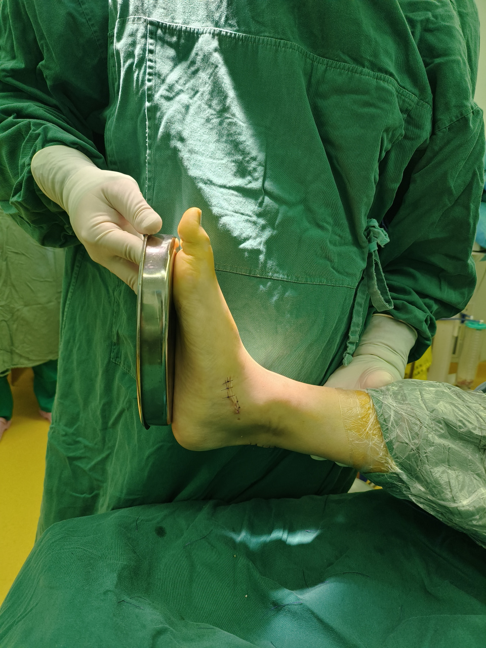 青少年扁平足#扁平足# ,微创治疗,让孩子足部更健康!