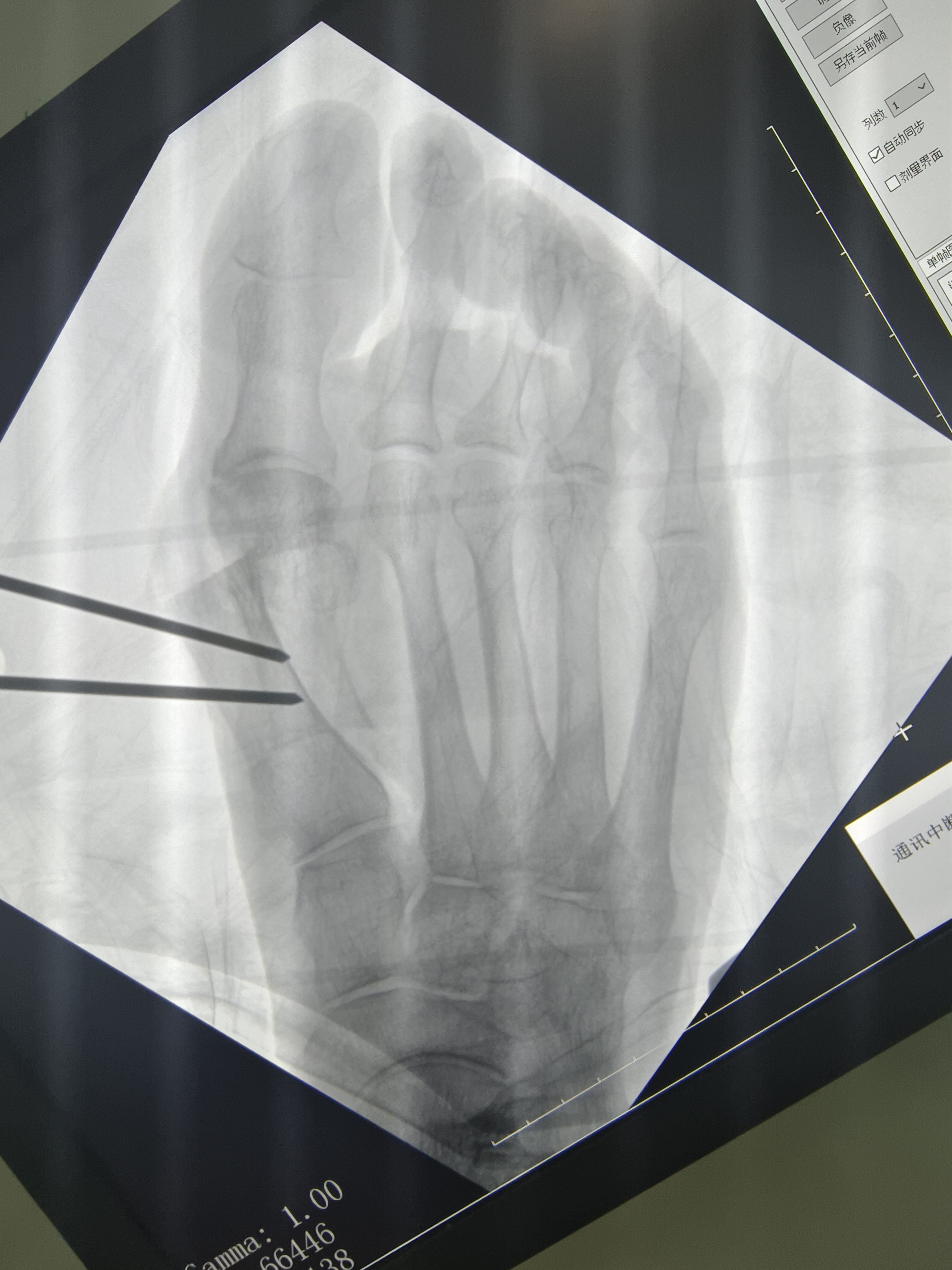 59岁女性拇外翻,前足足底大片胼胝体,自诉腿伸直时