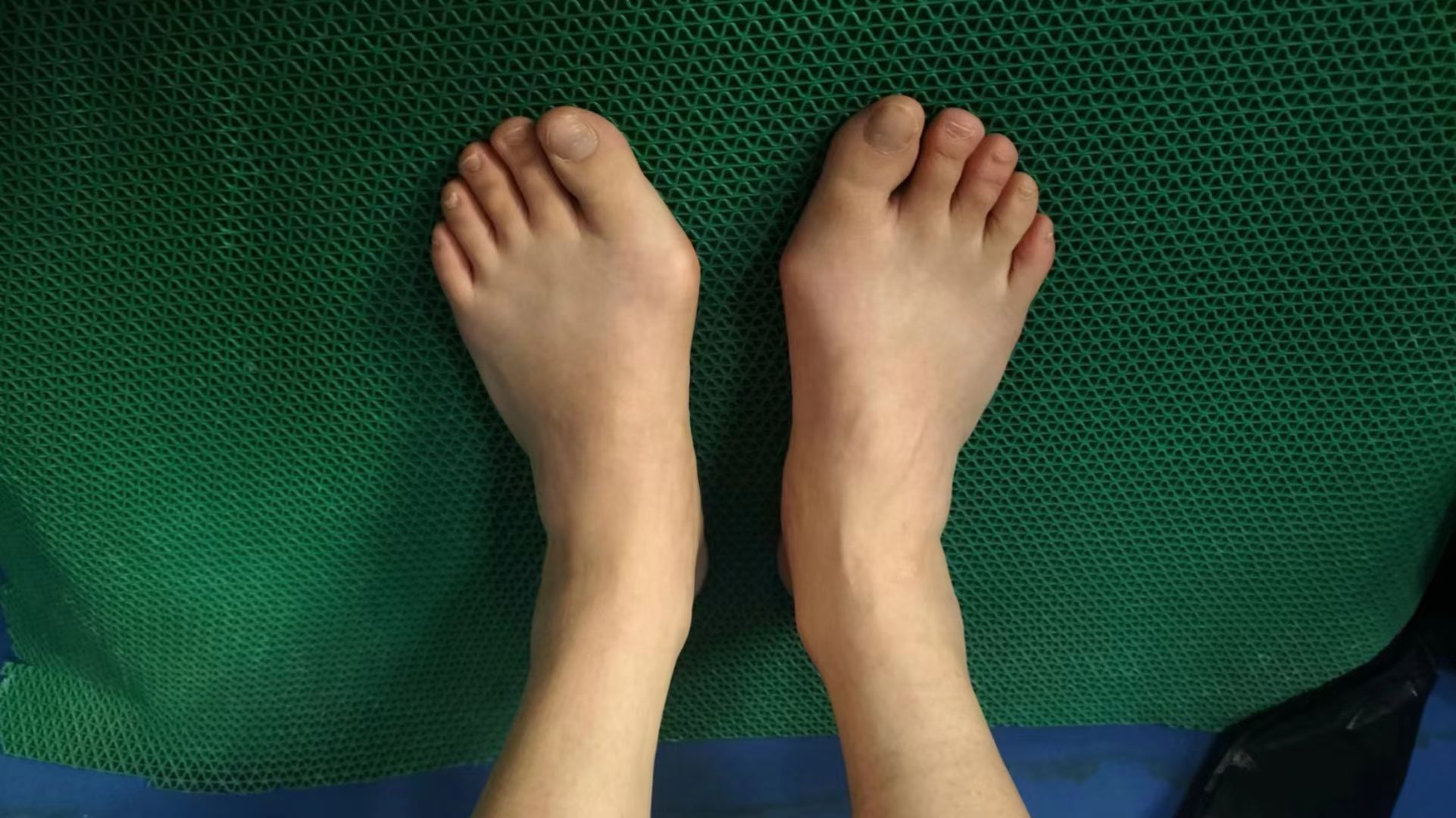 微创治疗拇外翻,不仅创伤小,美观,而且功能恢复的好!#拇外翻