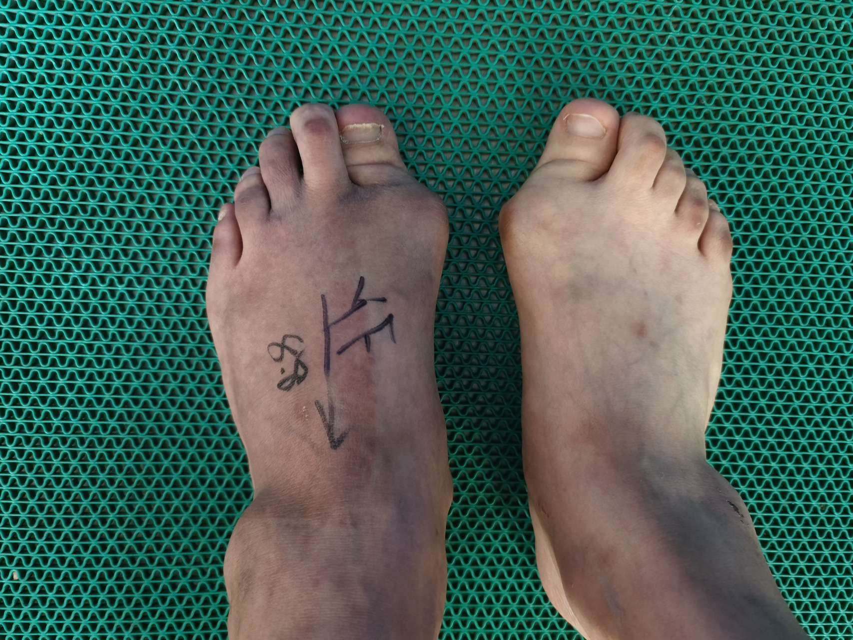 严重拇外翻,合并类风湿性关节炎,第4-5跖趾关节脱位#拇外翻