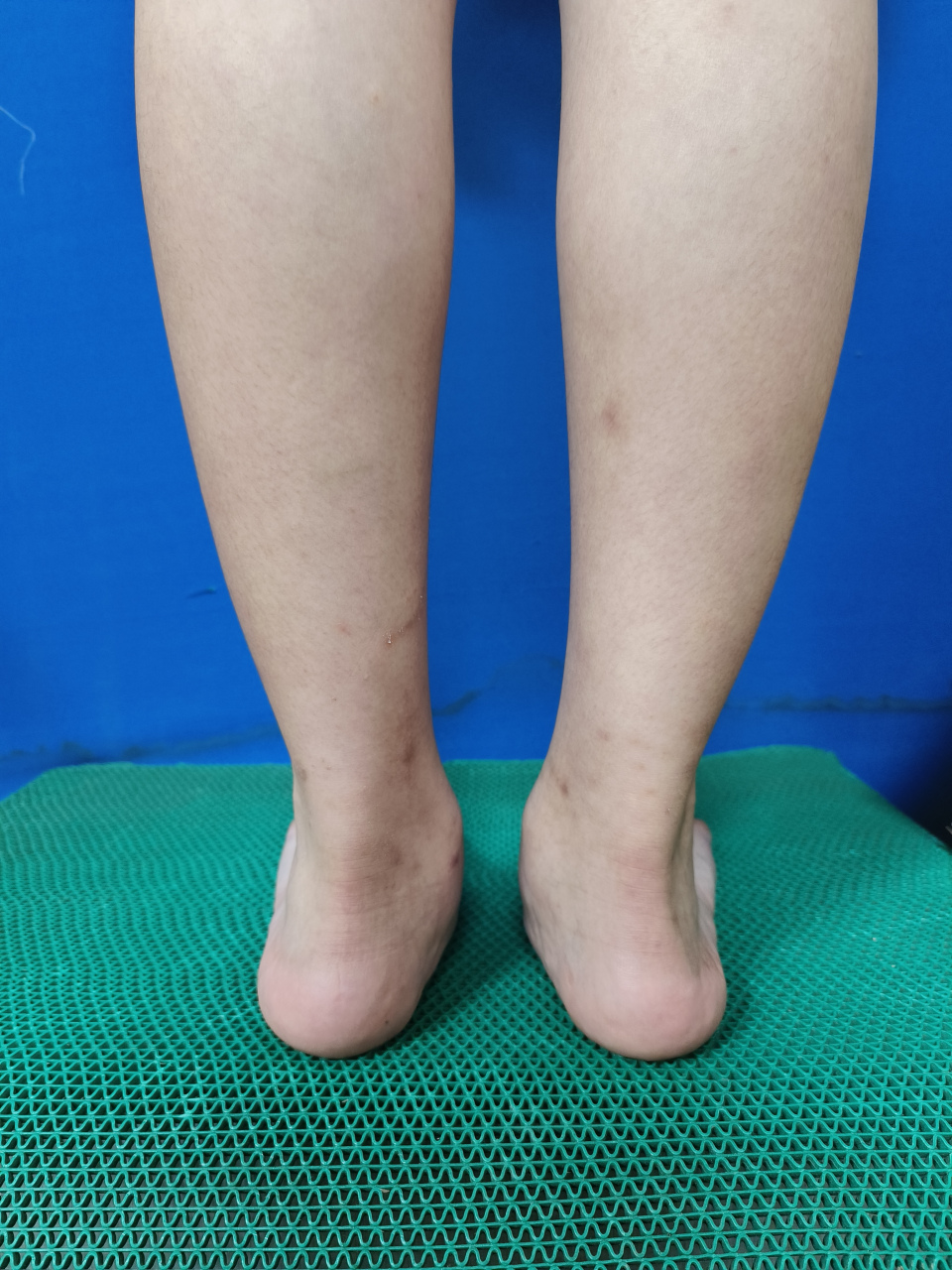 青少年扁平足#扁平足# ,微创治疗,让孩子足部更健康!