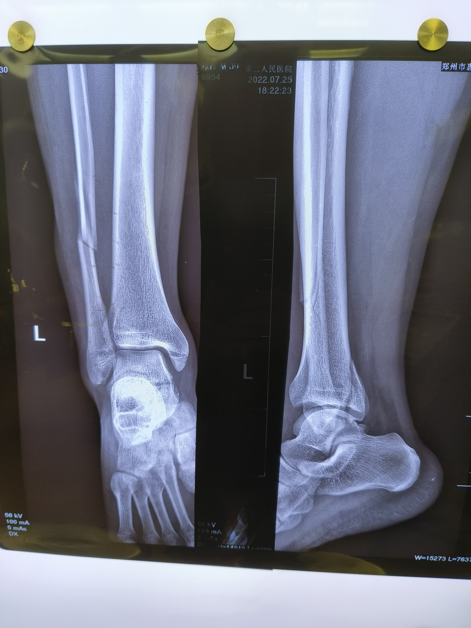 典型的#踝关节# #骨折# 旋前外旋4度,完美解剖复位.祝患者早日康复!