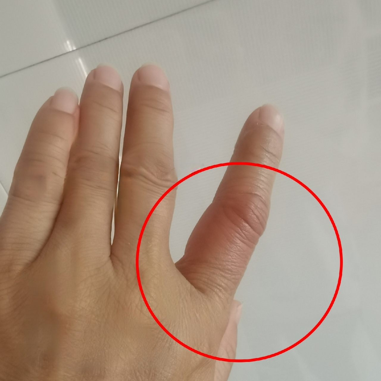 睡梦中感觉手指有点痒,挠了几下继续睡觉,早上起床后手指红肿,皮肤崩