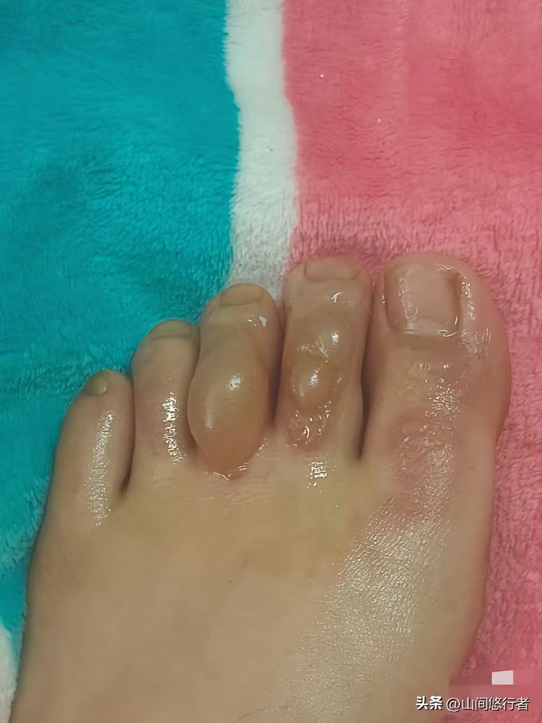 烫伤水泡图片被水烫起泡的图片腿刚刚烫起泡在医院图片缝合后伤口水泡