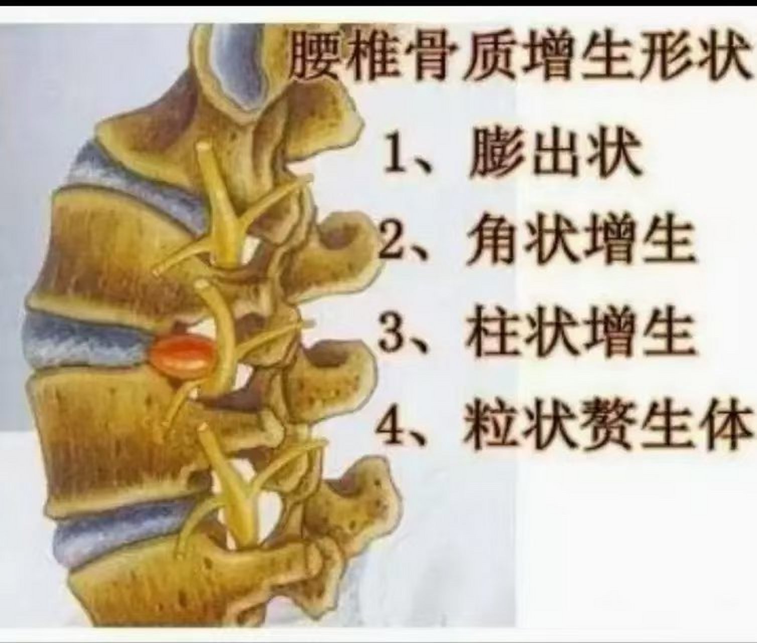 什么是椎腰骨质增生 腰椎质骨增生症是以腰骨椎质病理性增导生致