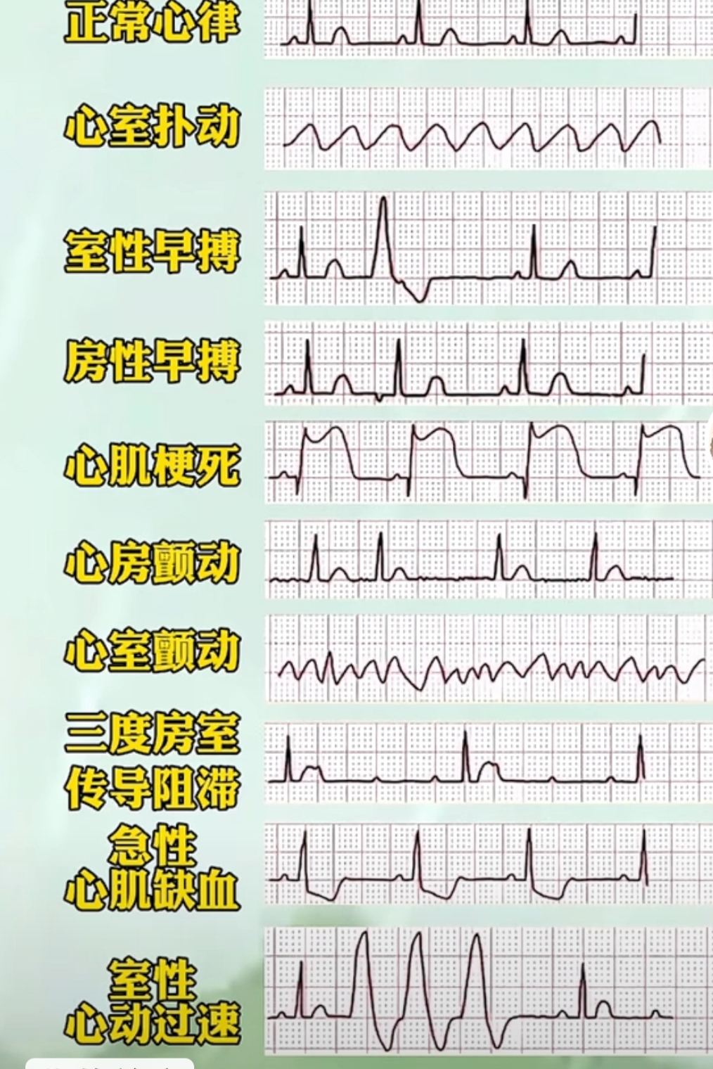 心室起搏心电图特点图片