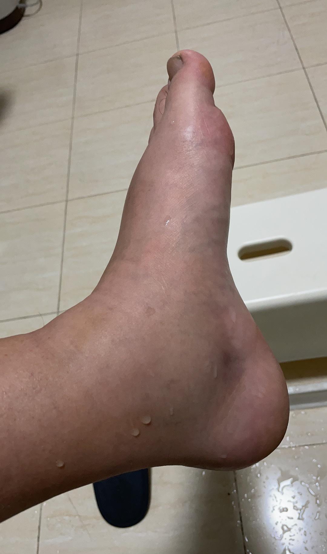 脚肿的像猪蹄