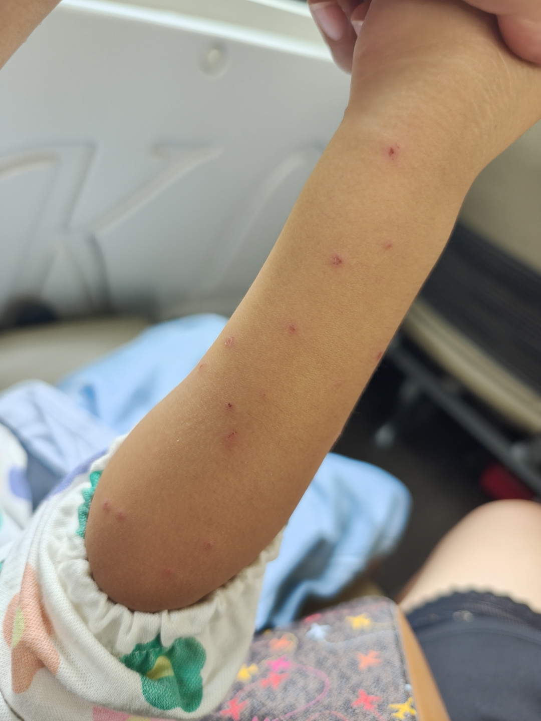 去趟庐山,蚊子没有,虫子很多,把闺女的小胳膊咬成这样