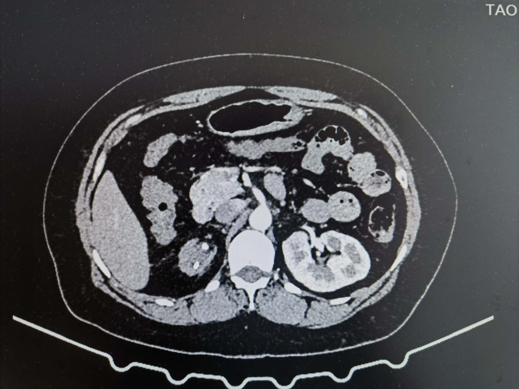 輸尿管結石致重度腎積水,反覆感染,腎失功,後腹腔鏡無功能腎切除,難度