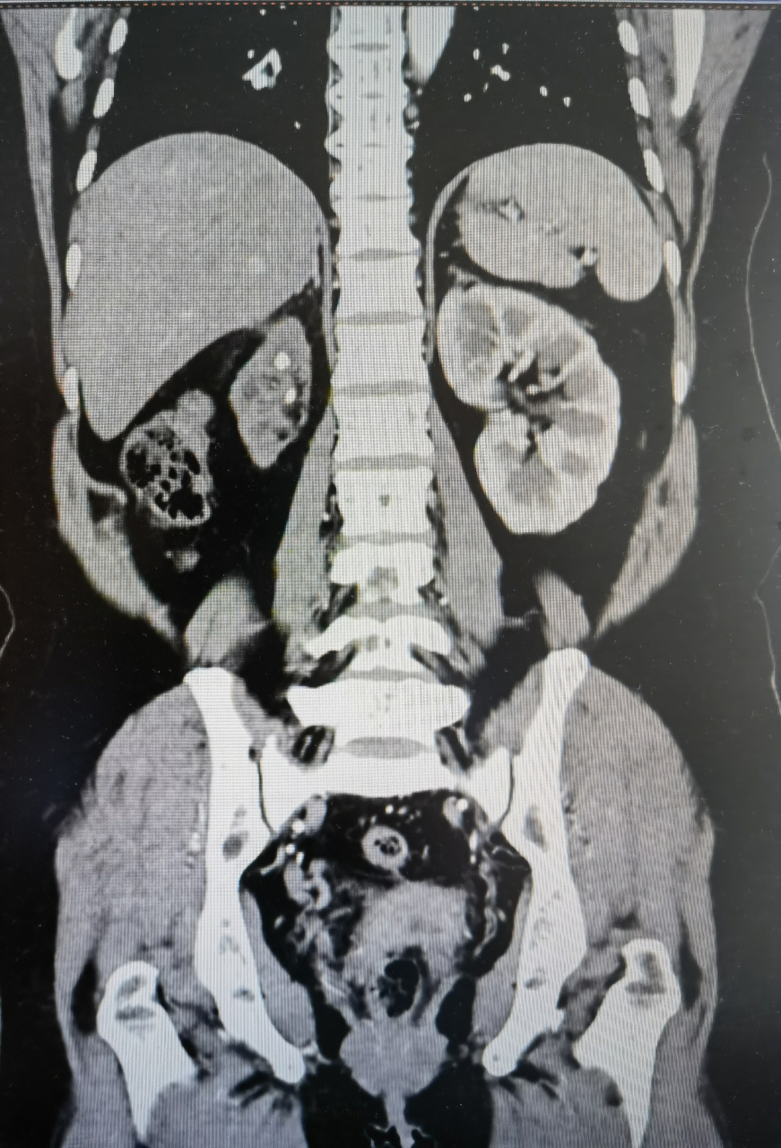 输尿管结石致重度肾积水,反复感染,肾失功,后腹腔镜无功能肾切除,难度