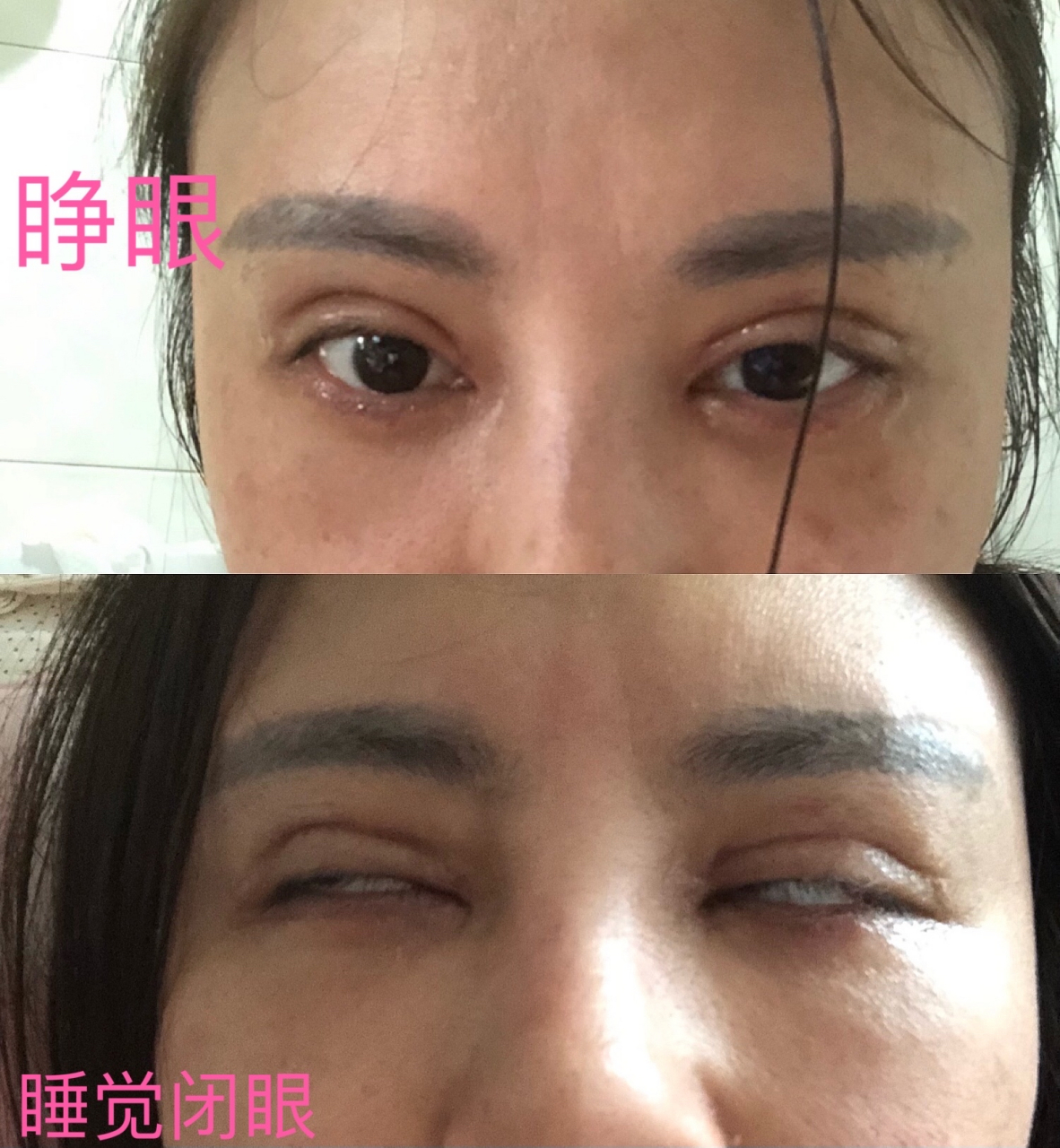 北京徐学东毁容 北京徐学东做双眼皮毁容 被身边朋友所谓的医托介绍