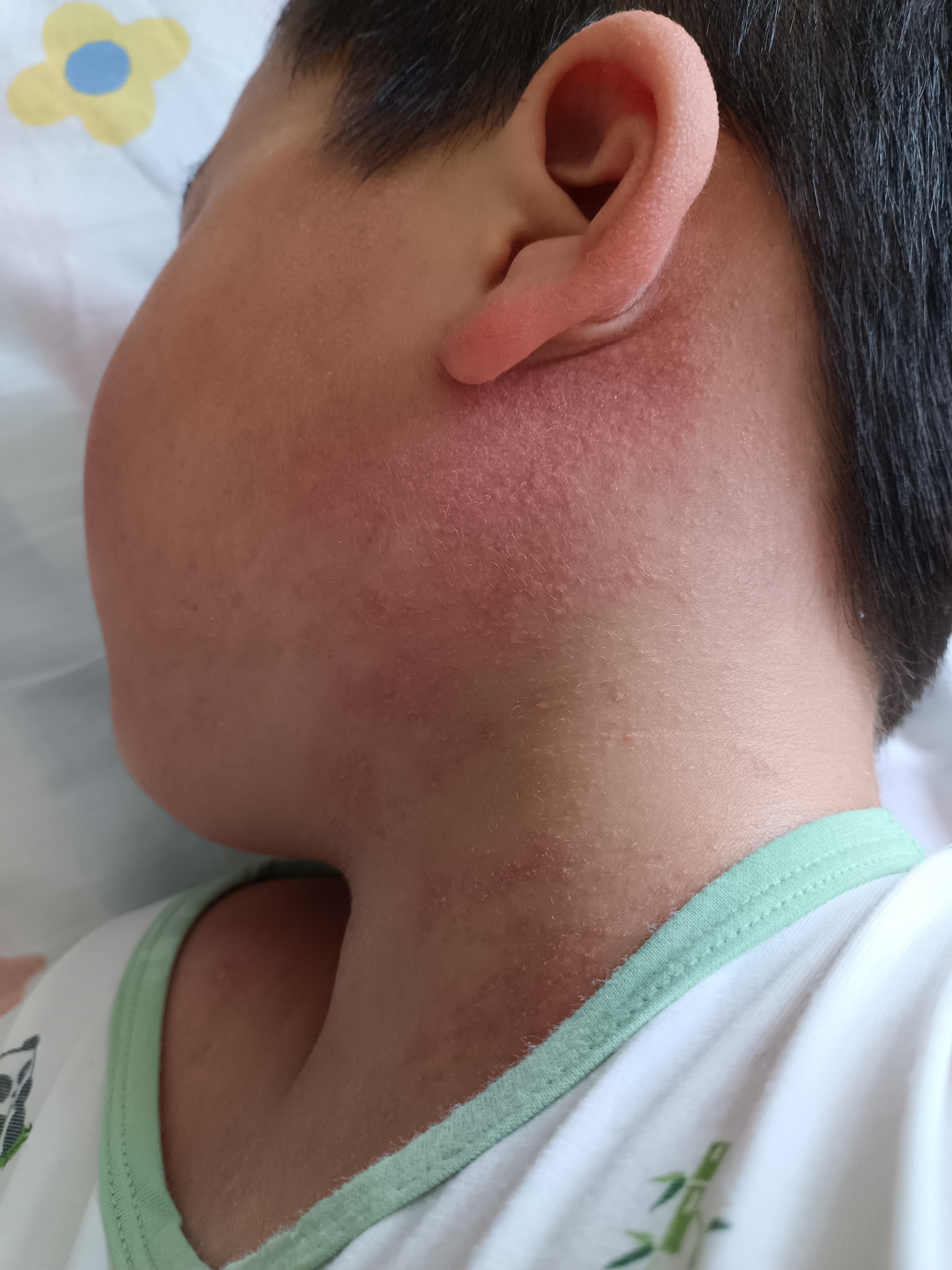 猩红热早期症状图片疹子的症状图片猩红热图片和症状图片儿童疹子的