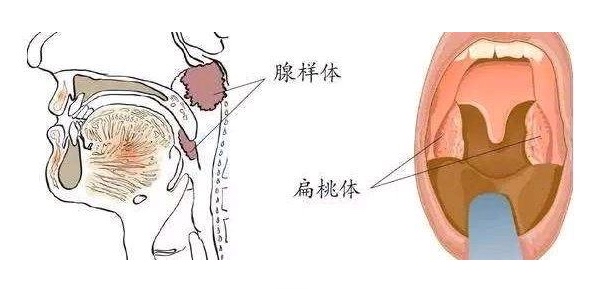 兒童腺樣體手術的利弊!