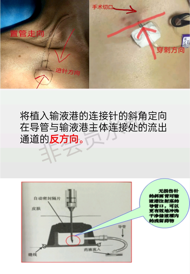 输液港置管位置图解图片