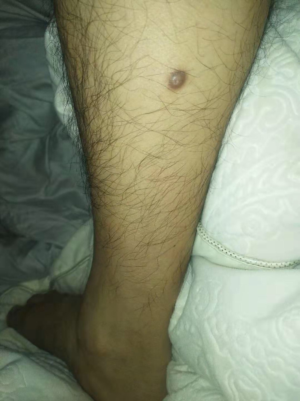 腿上长了这么一个瘤子,需要看医生吗?